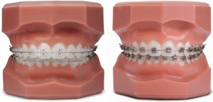 rechts metalen slotjes, links keramische slotjes